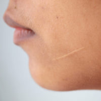 Facial scarring Facial scarring