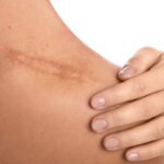 Woman with a scar on her shoulder Woman with a scar on her shoulder