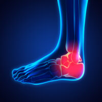 Ankle accident Ankle accident