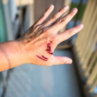 Focus dog bite wound and blood on hand. Infection and Rabies concept. Pet care and rabies prevention concept. Accidental and first aid concept.
